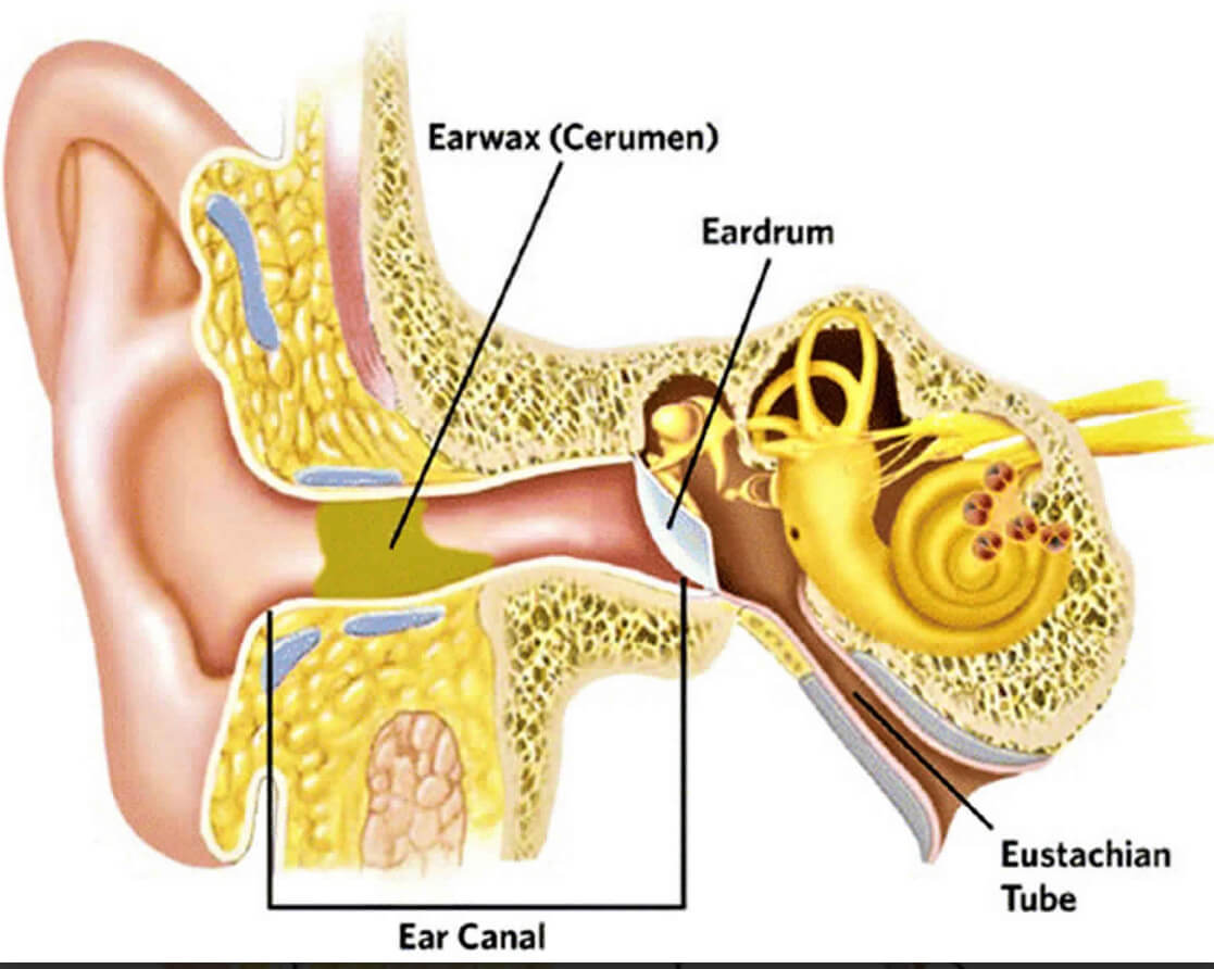 Graphic of a ear showing Cerumen (earwax) build up