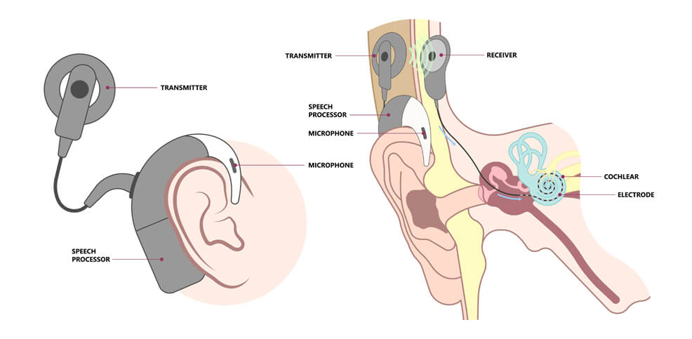 Diagram displaying the way a hearing aid works